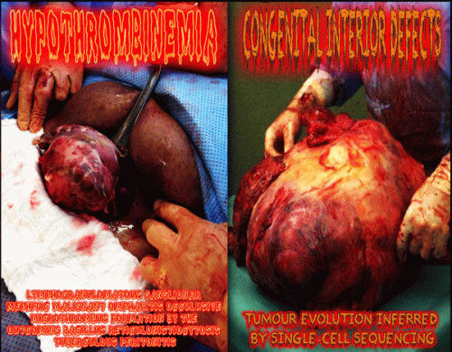 Congenital Interior Defects : Congenital Interior Defects - Hypoprothrombinemia Congenital Interior Defects : Congenital Interior Defects - Hypoprothrombinemia